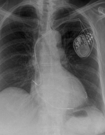 Pacemaker Image